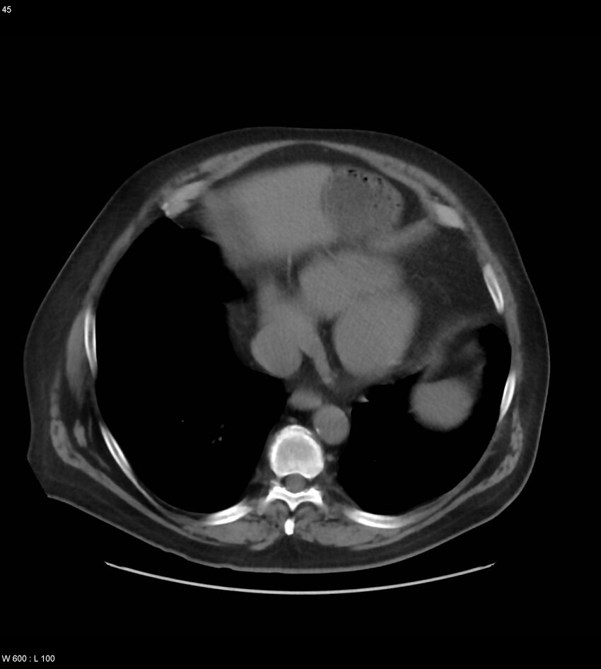 Abdominal aortic aneurysm with intramural hematoma then rupture (Radiopaedia 50278-55631 Axial non-contrast 41).jpg