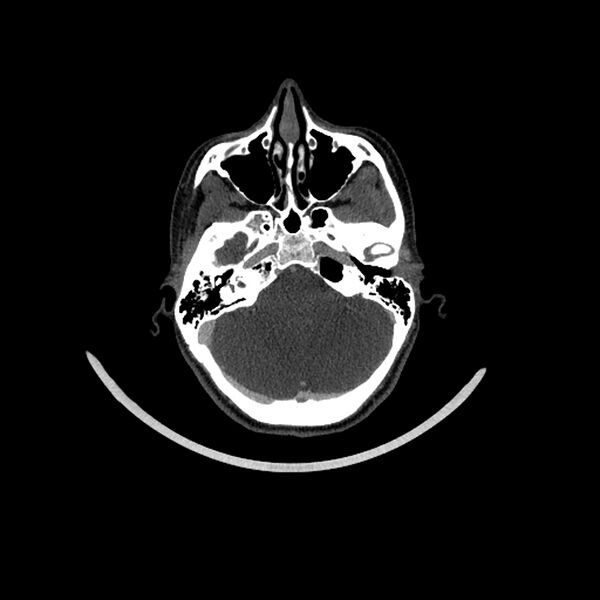 File:Aberrant right internal carotid artery (Radiopaedia 65191-74197 Axial C+ arterial phase 38).jpg