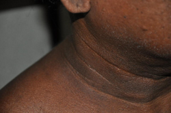 Acanthosis nigerians neck.png