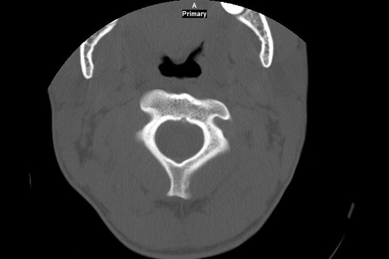 File:Accessory ossicle of the anterior arch of C1 vertebra (Radiopaedia 58149-65211 Axial bone window 12).jpg