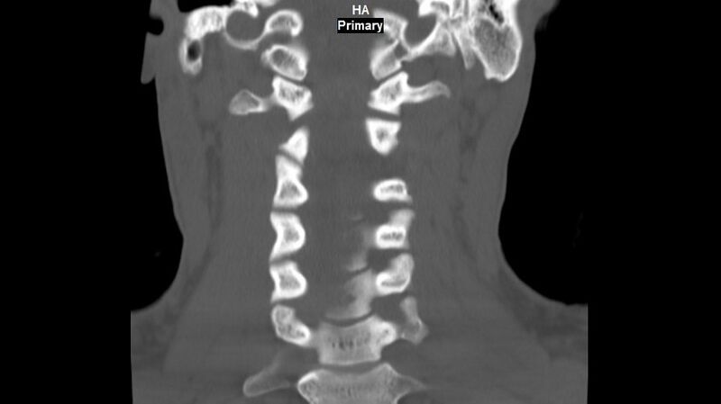 File:Accessory ossicle of the anterior arch of C1 vertebra (Radiopaedia 58149-65211 Coronal bone window 8).jpg
