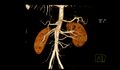 Accessory renal artery (Radiopaedia 52292).jpg