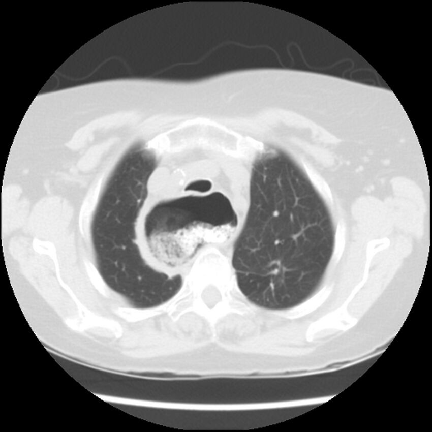 Achalasia (Radiopaedia 44094-47649 Axial lung window 11).jpg