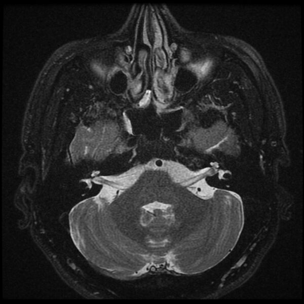 File:Acoustic schwannoma - intracanalicular (Radiopaedia 37247-39024 Axial T2 fat sat 7).jpg