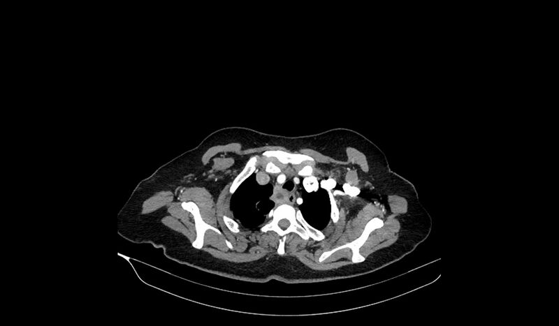 File:Acquired tracheo-esophageal fistula (Radiopaedia 51356-57103 Axial C+ arterial phase 19).jpg