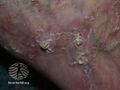 Actinic keratoses affecting the legs and feet (DermNet NZ lesions-ak-legs-477).jpg