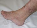 Actinic keratoses affecting the legs and feet (DermNet NZ lesions-ak-legs-509).jpg
