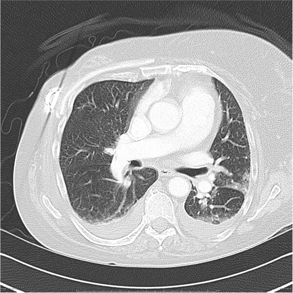 File:Acute-on-chronic pulmonary emboli (Radiopaedia 27925-28169 lung window 24).jpg