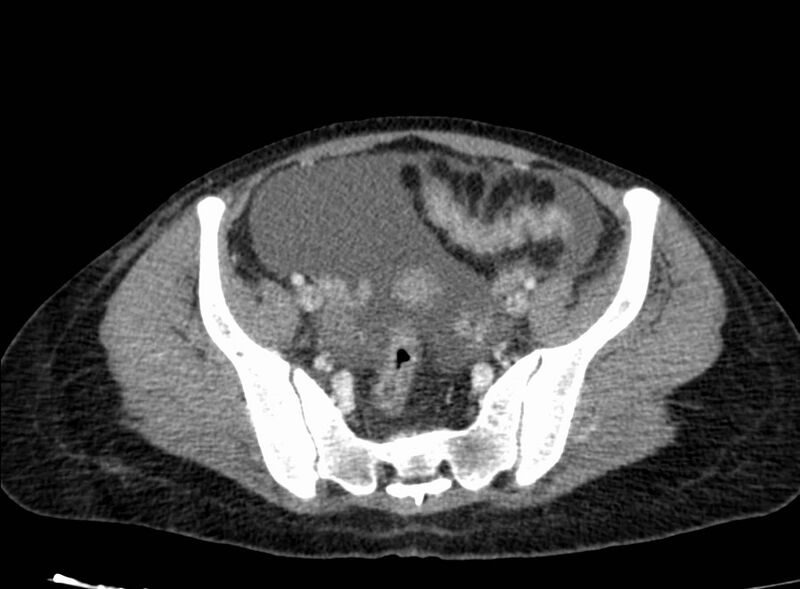 File:Acute Budd-Chiari syndrome (Radiopaedia 60858-68638 Axial C+ portal venous phase 241).jpg