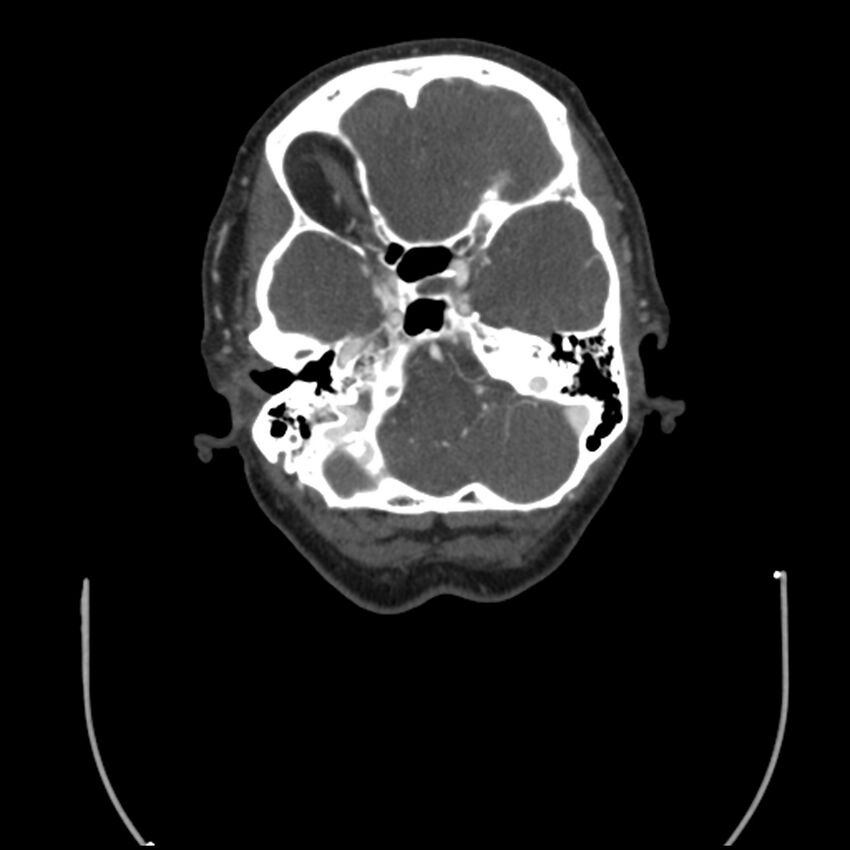 Acute M1 occlusion with ischemic penumbra (CT perfusion) (Radiopaedia 71897-82344 Axial C+ arterial phase thins 120).jpg