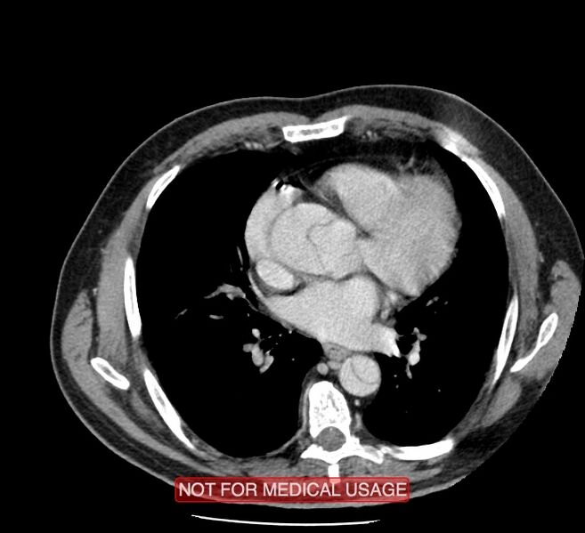 File:Acute aortic dissection - Stanford type A (Radiopaedia 40661-43285 Axial C+ portal venous phase 31).jpg