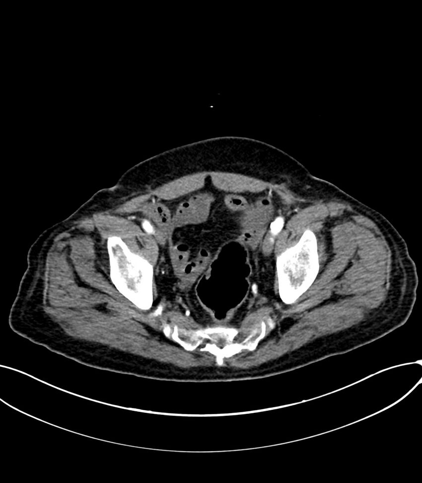 Acute arterial mesenteric ischemia (Radiopaedia 78238-90828 Axial C+ arterial phase 123).jpg