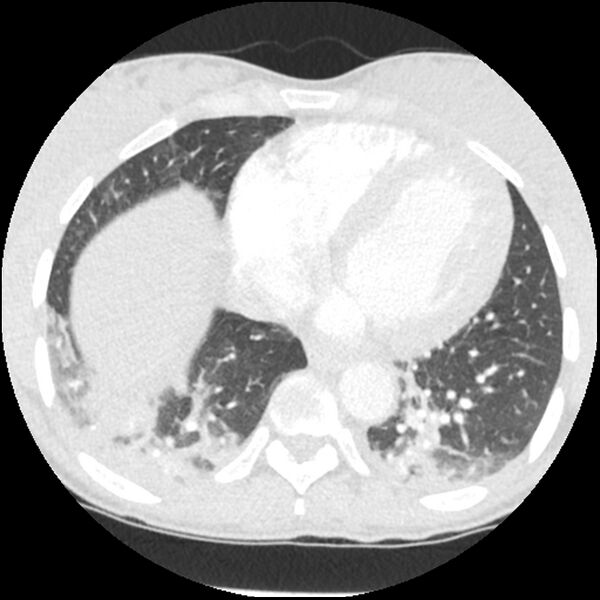 File:Acute chest syndrome - sickle cell disease (Radiopaedia 42375-45499 Axial lung window 139).jpg