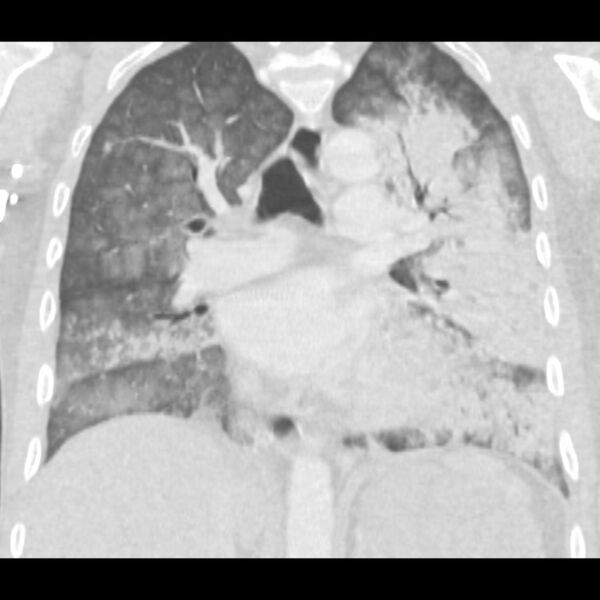 File:Acute diffuse alveolar hemorrhage (Radiopaedia 41323-44158 Coronal lung window 29).jpg