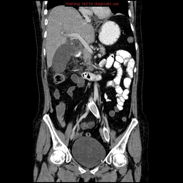 File:Acute gangrenous cholecystitis (Radiopaedia 10123-10661 Coronal C+ portal venous phase 13).jpg
