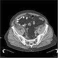 Acute pancreatitis (Radiopaedia 19135-19116 Axial non-contrast 49).jpg