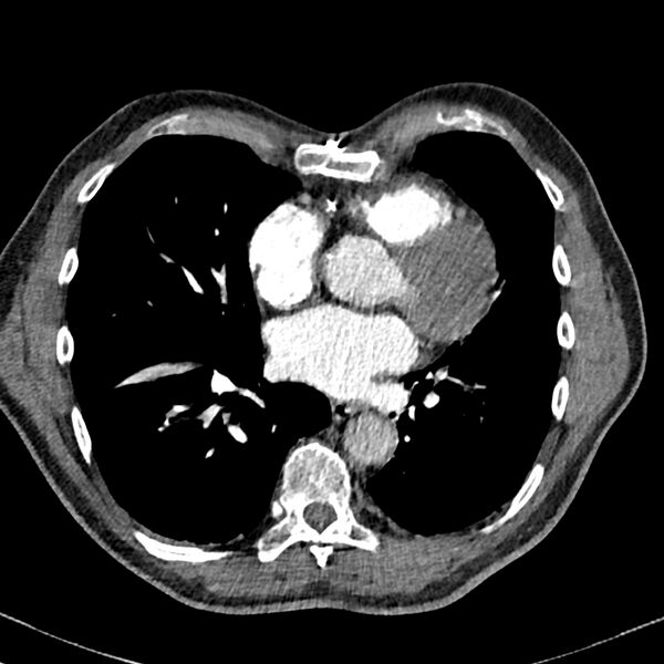 File:Acute pulmonary embolism (Radiopaedia 81677-95570 Axial C+ CTPA 72).jpg