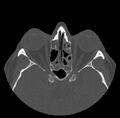 Acute sinusitis (Radiopaedia 23161-23215 Axial bone window 47).jpg