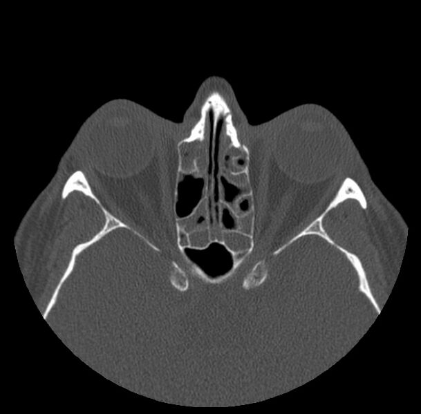 File:Acute sinusitis (Radiopaedia 23161-23215 Axial bone window 47).jpg