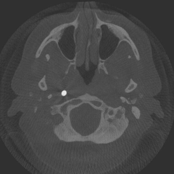 File:Acute subarachnoid hemorrhage and accessory anterior cerebral artery (Radiopaedia 69231-79010 Axial arterial - MIP 4).jpg