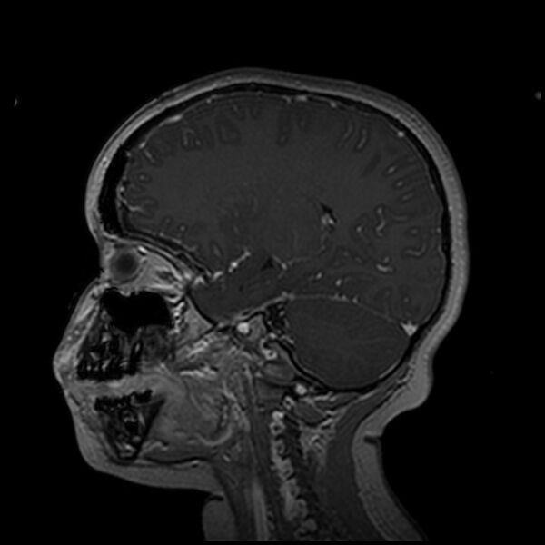 File:Adamantinomatous craniopharyngioma (Radiopaedia 77407-89529 H 77).jpg
