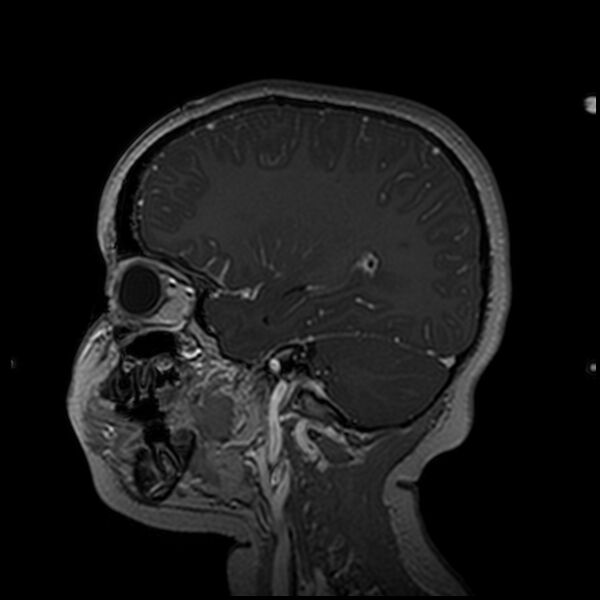 File:Adamantinomatous craniopharyngioma (Radiopaedia 77407-89529 H 82).jpg