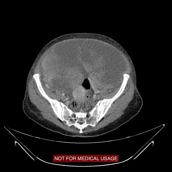 File:Adenocarcinoma of the cervix (Radiopaedia 28373-28616 Axial C+ portal venous phase 15).jpg