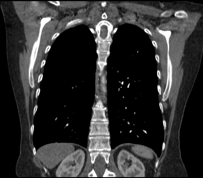 File:Adenocarcinoma of the lung (Radiopaedia 44205-47803 Coronal C+ portal venous phase 70).jpg