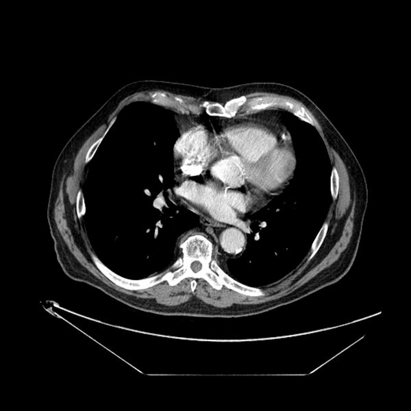 File:Adenocarcinoma of the lung (Radiopaedia 44876-48759 Axial C+ portal venous phase 49).jpg
