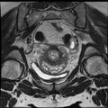 Adenoma malignum of the cervix (Radiopaedia 24460-24765 Coronal T2 16).jpg