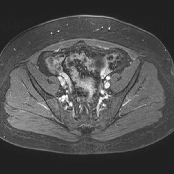 File:Adenomyoma of the uterus (Radiopaedia 9871-10439 Axial T1 C+ fat sat 18).jpg