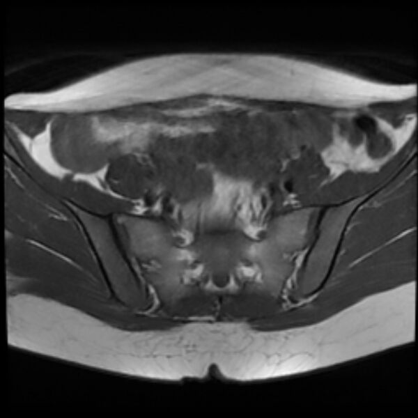 File:Adenomyosis within a septate uterus (Radiopaedia 69963-79981 Axial T1 9).jpg