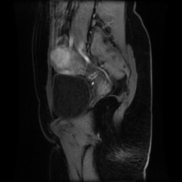 File:Adenomyosis within a septate uterus (Radiopaedia 69963-79981 Sagittal LAVA-Dyn 25).jpg