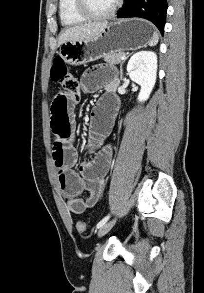 File:Adhesional small bowel obstruction (Radiopaedia 58900-66131 Sagittal C+ portal venous phase 162).jpg