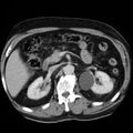 Adrenal hemangioma (Radiopaedia 11039-11445 Axial C+ portal venous phase 12).jpg