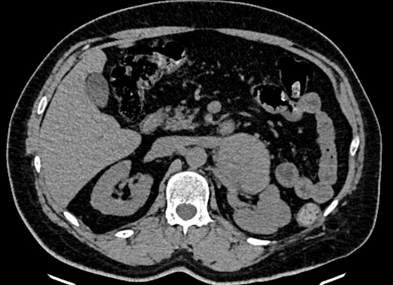 File:Adrenal metastases (Radiopaedia 73082-83791 Axial non-contrast 67).jpg