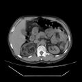 Adrenal myelolipoma (Radiopaedia 41843-44834 Axial non-contrast 24).jpg