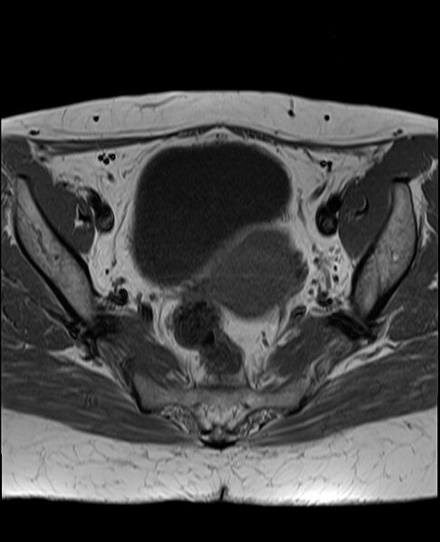 File:Adult granulosa cell tumor of the ovary (Radiopaedia 71581-81950 Axial T1 14).jpg
