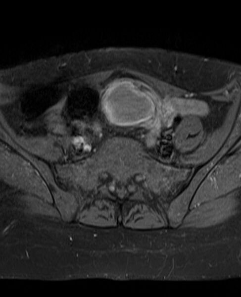 File:Adult granulosa cell tumor of the ovary (Radiopaedia 71581-81950 Axial T1 C+ fat sat 8).jpg