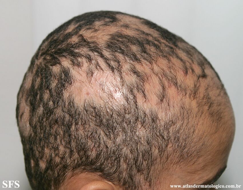 Alopecia Areata (Dermatology Atlas 65).jpg