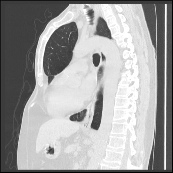 File:Alpha-1-antitrypsin deficiency (Radiopaedia 40993-43722 Sagittal lung window 126).jpg