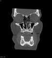 Ameloblastoma (Radiopaedia 18115-17901 Axial bone window 19).jpg