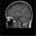 Amnestic syndrome secondary to hypoxic brain injury (Radiopaedia 24743-25004 T1 12).jpg