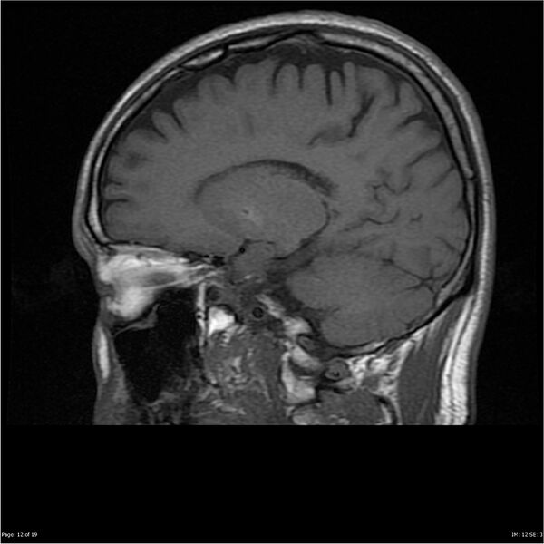 File:Amnestic syndrome secondary to hypoxic brain injury (Radiopaedia 24743-25004 T1 12).jpg