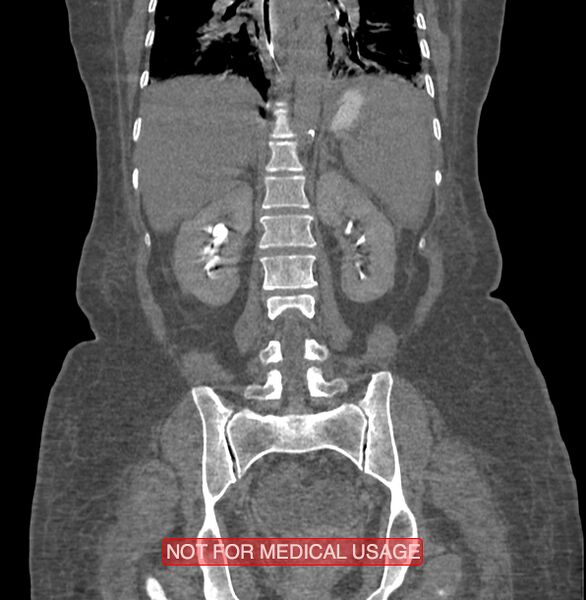 File:Amoebic enterocolitis with liver abscess (Radiopaedia 35100-36609 B 140).jpg