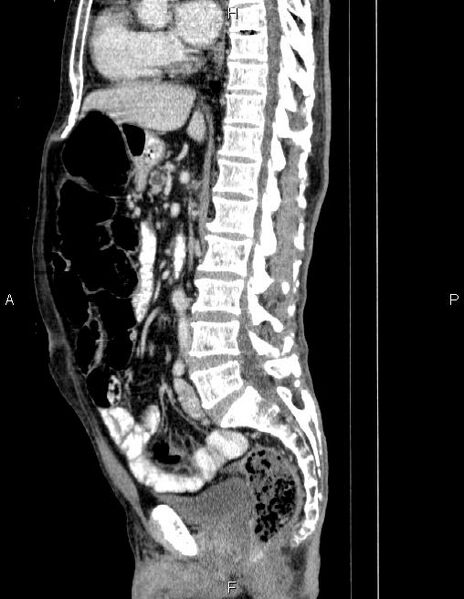 File:Ampullary adenocarcinoma (Radiopaedia 86093-102032 D 48).jpg