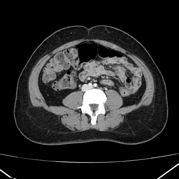 File:Ampullary tumor (Radiopaedia 22787-22816 C 39).jpg