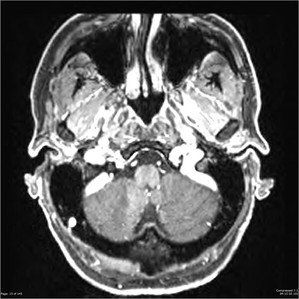 File:Anaplastic meningioma with recurrence (Radiopaedia 34452-35788 Axial T1 C+ 15).jpg
