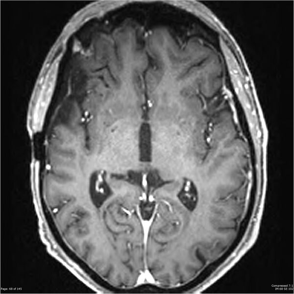 File:Anaplastic meningioma with recurrence (Radiopaedia 34452-35788 Axial T1 C+ 68).jpg