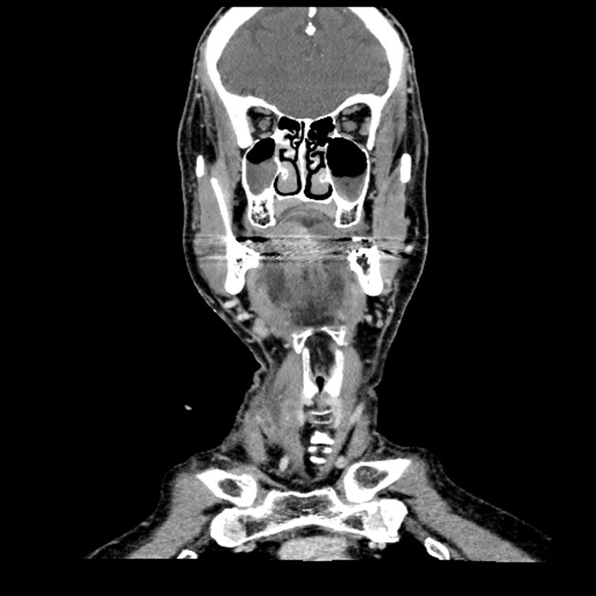 Anaplastic thyroid carcinoma (Radiopaedia 79087-92034 A 45).jpg
